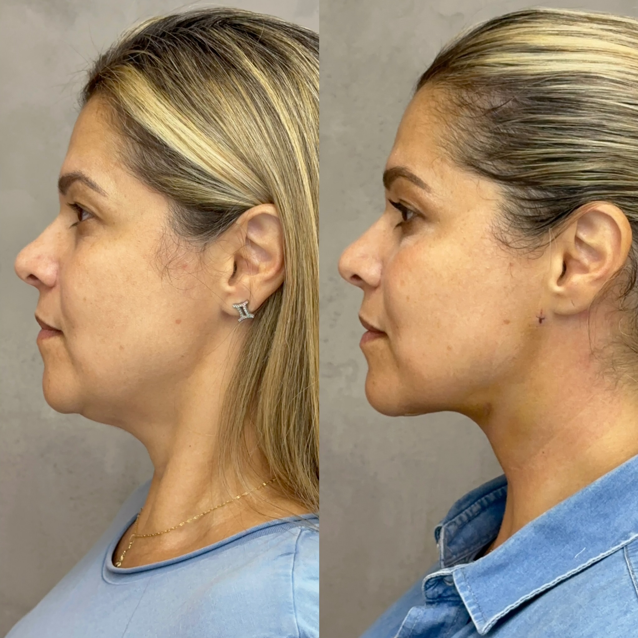 Antes e depois lipo de papada