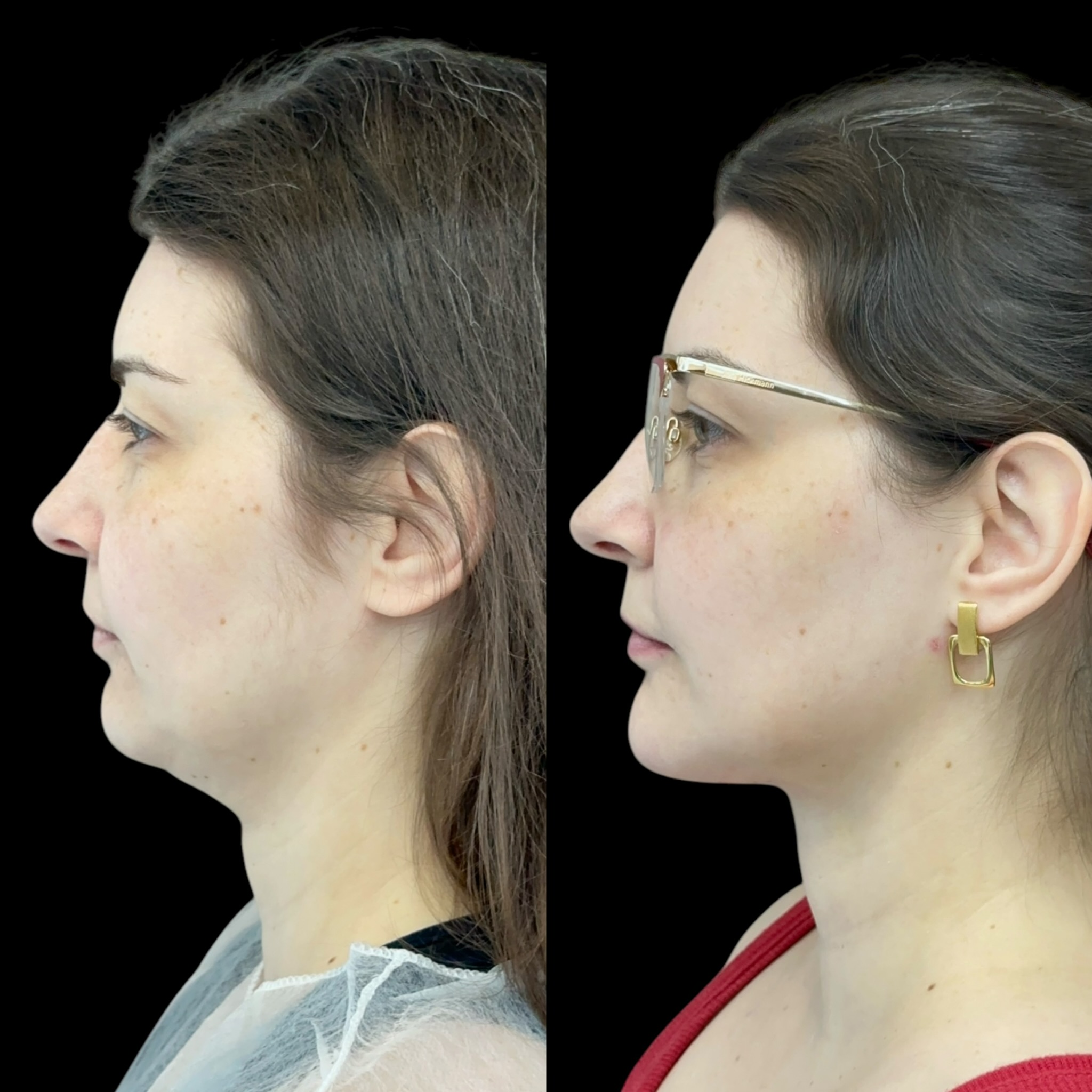 Antes e depois lipo de papada